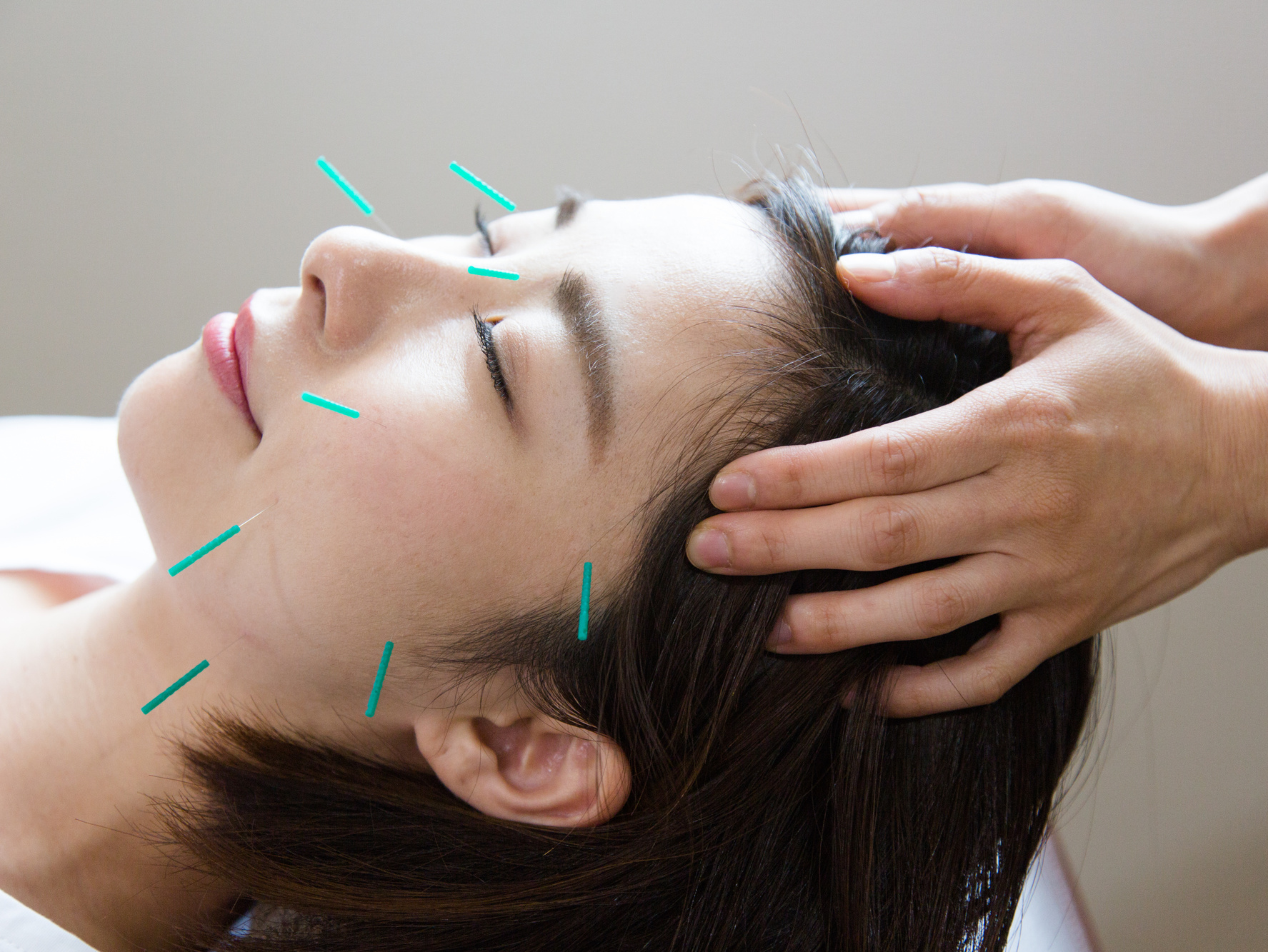 美容鍼